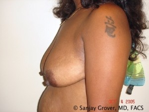 Breast Lift Before and After 19 | Grover Aesthetics
