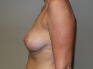 Breast Lift Before and After 20 | Sanjay Grover MD FACS