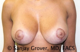 Breast Lift Before and After 21 | Sanjay Grover MD FACS