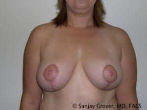 Breast Lift Before and After 21 | Sanjay Grover MD FACS