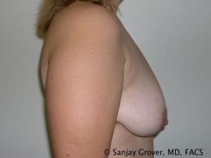 Breast Lift Before and After 21 | Sanjay Grover MD FACS