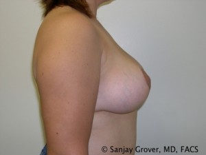 Breast Lift Before and After 21 | Sanjay Grover MD FACS