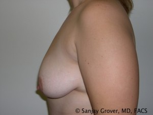 Breast Lift Before and After 21 | Sanjay Grover MD FACS