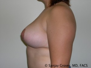 Breast Lift Before and After 21 | Sanjay Grover MD FACS