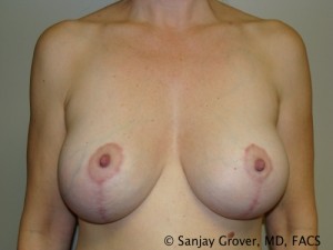 Breast Lift Before and After | Sanjay Grover MD FACS