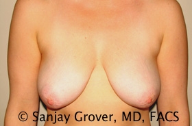 Breast Lift Before and After 36 | Sanjay Grover MD FACS