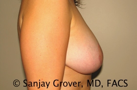 Breast Lift Before and After 23 | Sanjay Grover MD FACS