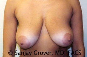 Breast Lift Before and After 39 | Sanjay Grover MD FACS