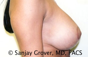 Breast Lift Before and After 24 | Sanjay Grover MD FACS