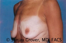 Breast Lift Before and After 01 | Sanjay Grover MD FACS