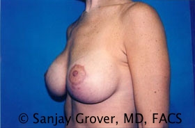 Breast Lift Before and After 25 | Grover Aesthetics