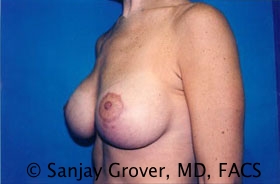 Breast Lift Before and After 25 | Sanjay Grover MD FACS