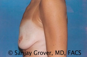 Breast Lift Before and After 25 | Sanjay Grover MD FACS