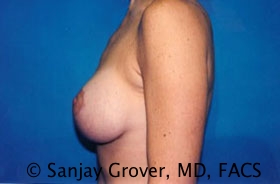 Breast Lift Before and After 25 | Grover Aesthetics