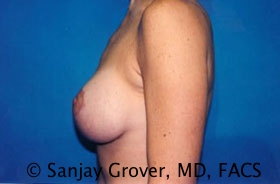 Breast Lift Before and After 25 | Sanjay Grover MD FACS