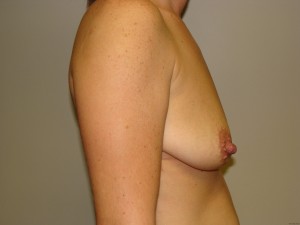 Breast Lift Before and After 25 | Sanjay Grover MD FACS