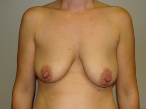 Breast Lift Before and After 04 | Sanjay Grover MD FACS