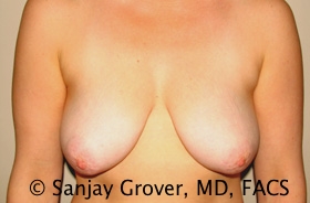 Breast Lift Before and After 09 | Sanjay Grover MD FACS