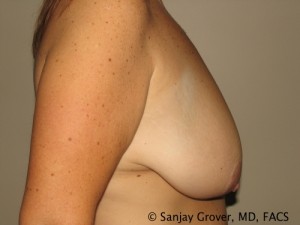 Breast Lift Before and After 27 | Sanjay Grover MD FACS