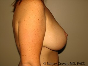 Breast Lift Before and After 27 | Sanjay Grover MD FACS