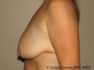 Breast Lift Before and After 27 | Sanjay Grover MD FACS