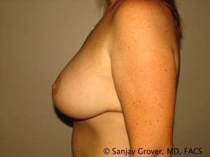 Breast Lift Before and After 27 | Sanjay Grover MD FACS