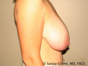 Breast Lift Before and After 28 | Sanjay Grover MD FACS
