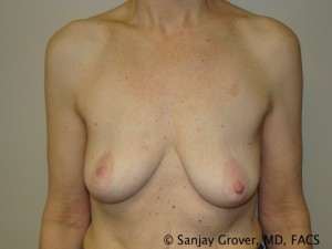 Breast Lift Before and After 14 | Sanjay Grover MD FACS