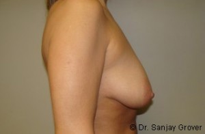 Breast Lift Before and After 29 | Sanjay Grover MD FACS