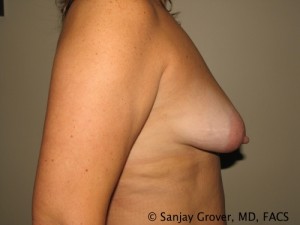 Breast Lift Before and After 30 | Grover Aesthetics