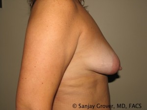 Breast Lift Before and After 30 | Sanjay Grover MD FACS