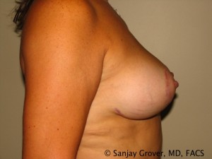 Breast Lift Before and After 30 | Grover Aesthetics