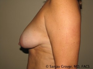 Breast Lift Before and After 30 | Sanjay Grover MD FACS