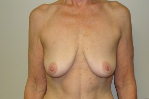 Breast Lift Before and After 37 | Sanjay Grover MD FACS