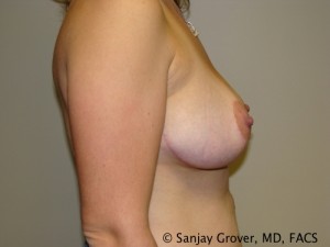 Breast Lift Before and After 31 | Sanjay Grover MD FACS