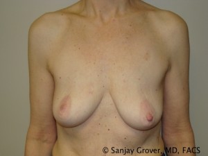 Breast Lift Before and After 39 | Sanjay Grover MD FACS