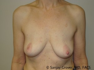 Breast Lift Before and After 12 | Sanjay Grover MD FACS