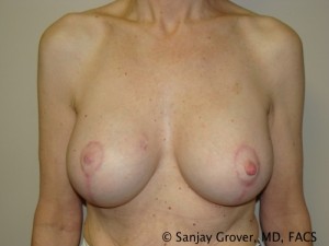 Breast Lift Before and After 32 | Sanjay Grover MD FACS