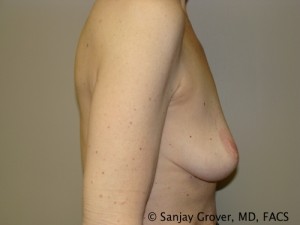 Breast Lift Before and After 32 | Sanjay Grover MD FACS