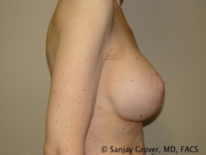 Breast Lift Before and After 32 | Sanjay Grover MD FACS