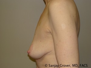 Breast Lift Before and After 32 | Sanjay Grover MD FACS