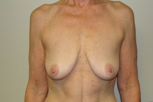 Breast Lift Before and After 19 | Sanjay Grover MD FACS