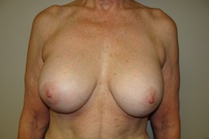 Breast Lift Before and After 33 | Grover Aesthetics