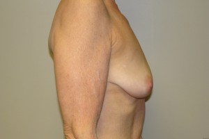 Breast Lift Before and After 33 | Grover Aesthetics
