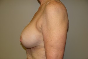 Breast Lift Before and After 33 | Sanjay Grover MD FACS