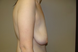 Breast Lift Before and After 34 | Sanjay Grover MD FACS