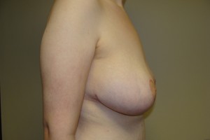 Breast Lift Before and After 34 | Sanjay Grover MD FACS