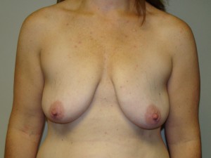 Breast Lift Before and After 25 | Sanjay Grover MD FACS