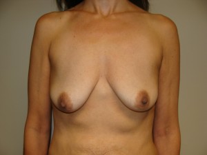 Breast Lift Before and After 42 | Sanjay Grover MD FACS