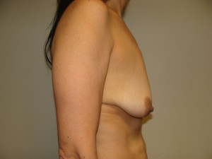 Breast Lift Before and After 38 | Grover Aesthetics